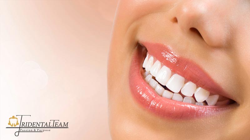 درمان تغییر رنگ لمینت دندان