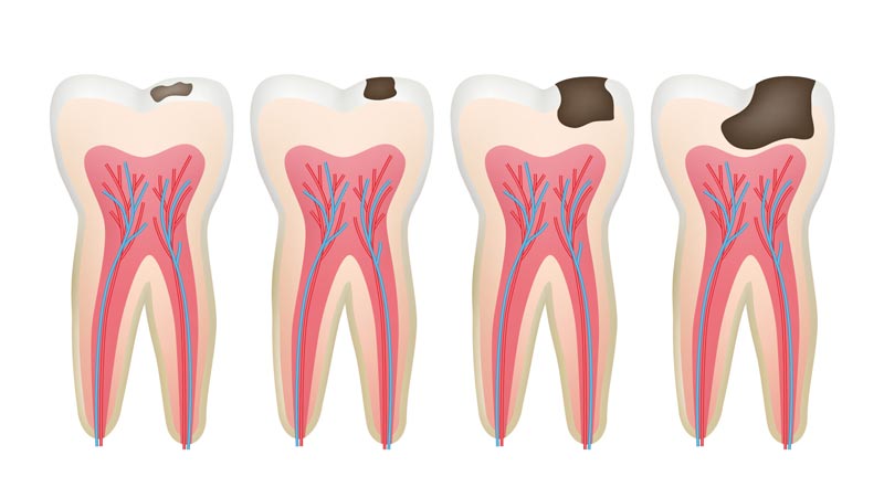 درمان پوسیدگی دندان در تهران