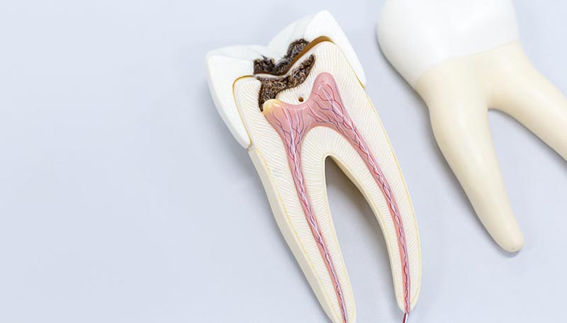 درمان پوسیدگی دندان