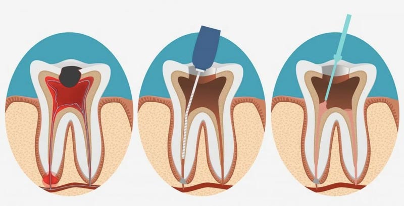دکتر ریشه دندان تهران