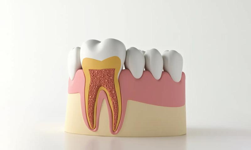 عصب کشی دندان عقل