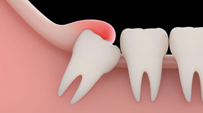 عصب کشی دندان عقل