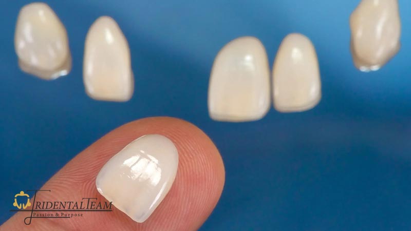 لمینت ایمکس emax چیست