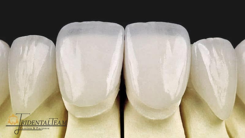 لمینت ایمکس دندان emax