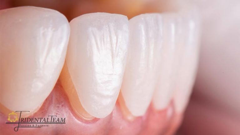 لمینت ایمکس دندان emax