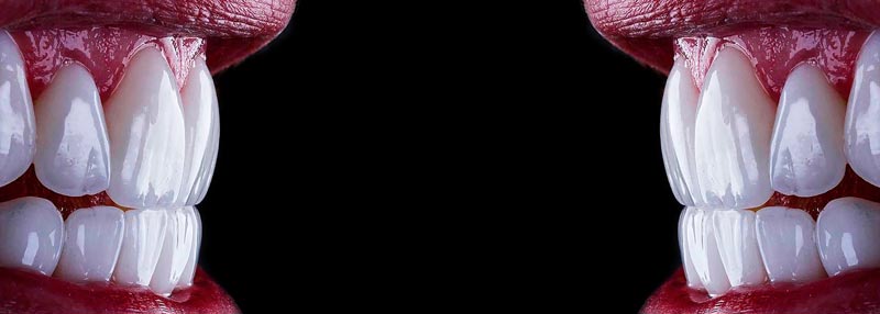 لمینت دندان بدون تراش در تهران