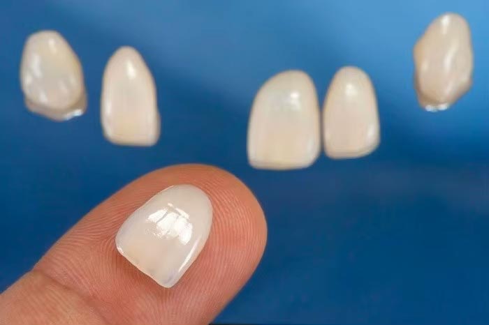 لمینت دندان بدون تراش 