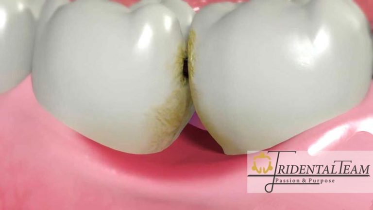 پوسیدگی بین دندان
