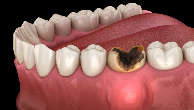 درمان های پوسیدگی دندان