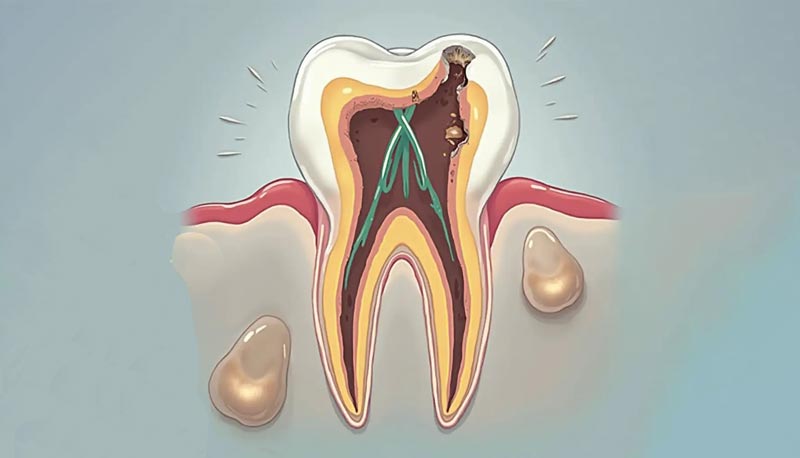 پوسیدگی دندان