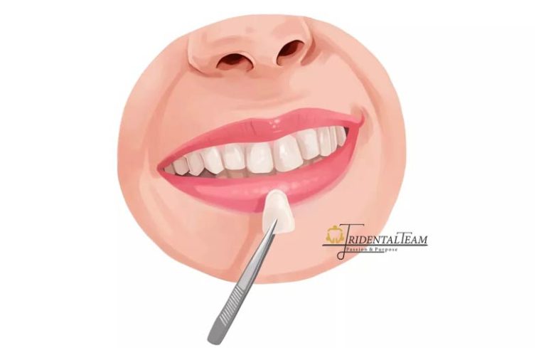 تعویض کامپوزیت دندان