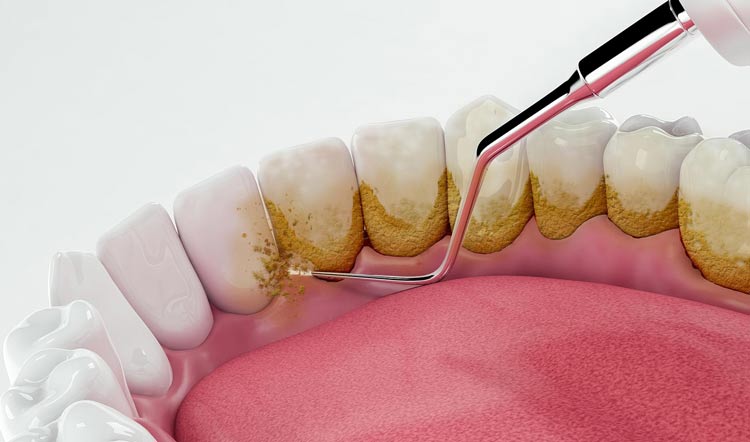 جرم گیری دندان های لمینت شده