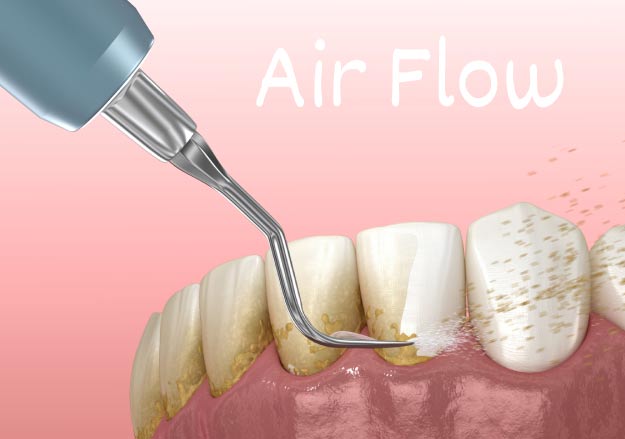 روش های جرم گیری دندان های لمینت شده