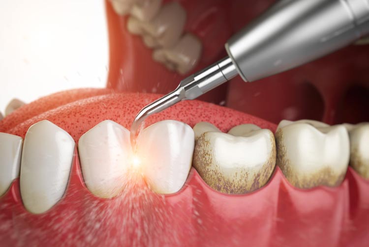 جرم گیری دندان لمینت شده