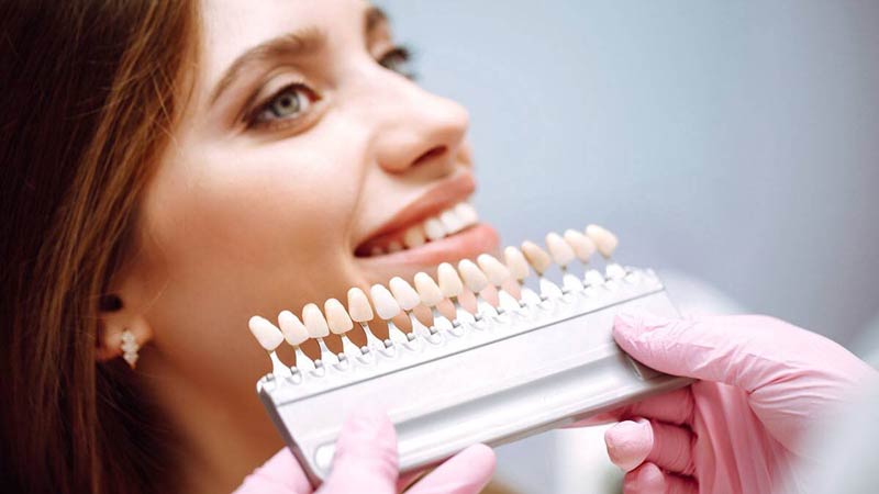 کامپوزیت ونیر دندان