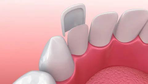 تراش دندان برای کامپوزیت