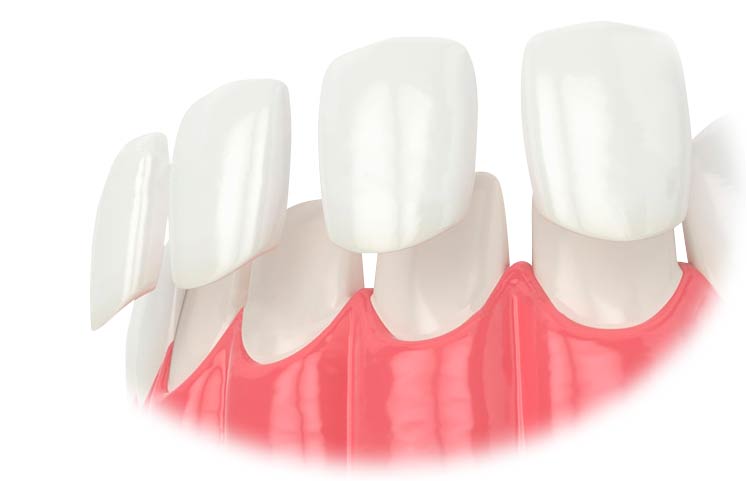 تراش دندان برای کامپوزیت