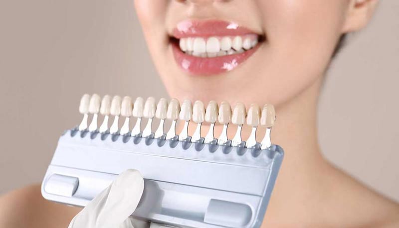 انواع لمینت دندان