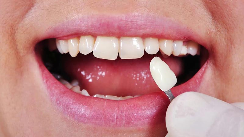 مزایای انواع لمینت دندان