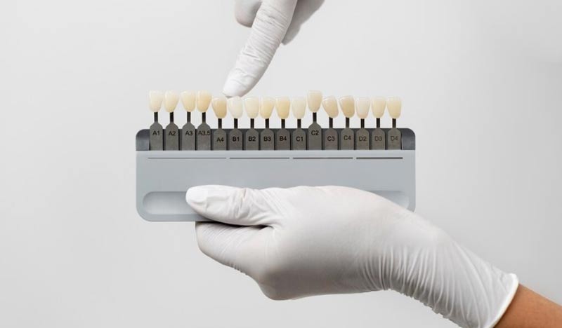 کدام نوع لمینت دندان برای شما مناسب تر است