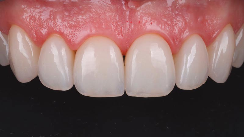 انواع لمینت دندان