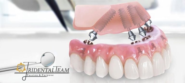 ایمپلنت all on 4