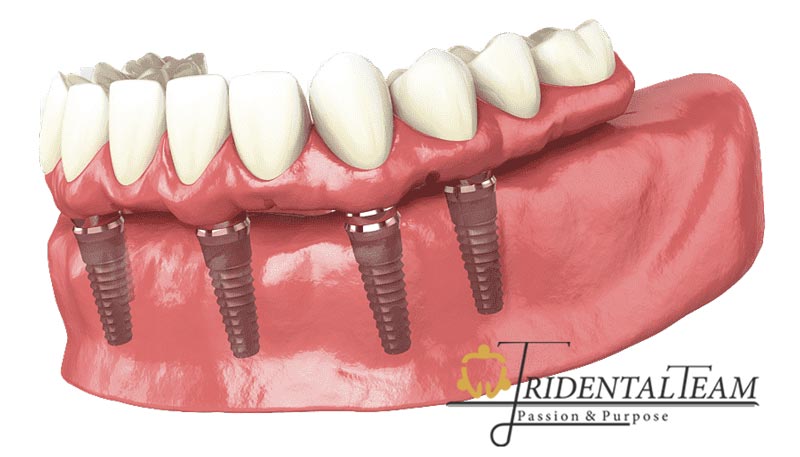 مقایسه هزینه ایمپلنت all on 4