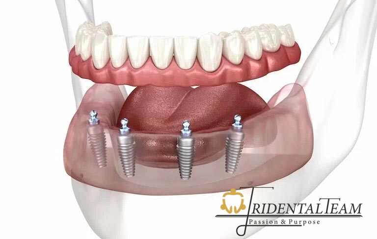 ایمپلنت all on 4 در تهران
