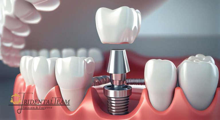 ایمپلنت تک دندان