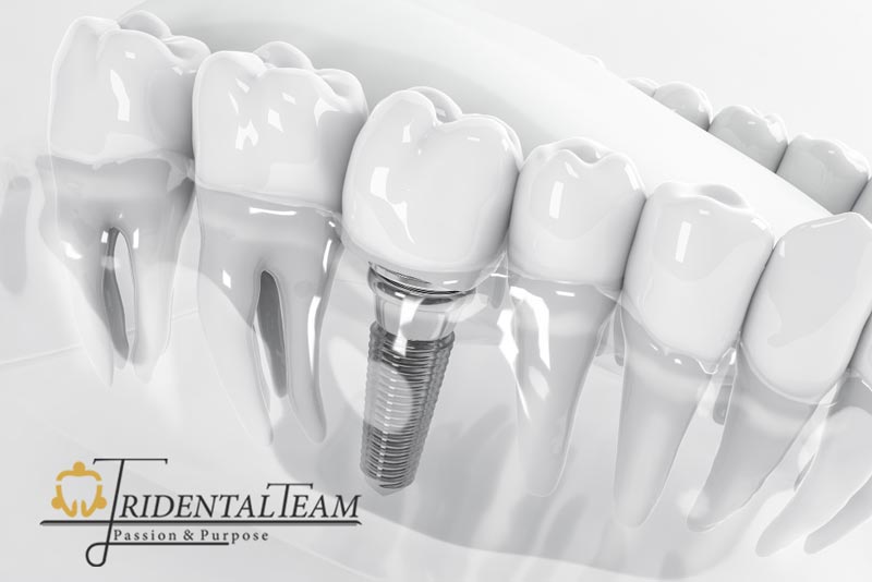 ایمپلنت تک دندان چیست؟