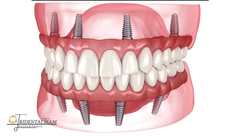 ایمپلنت کامل دو فک بالا و پایین