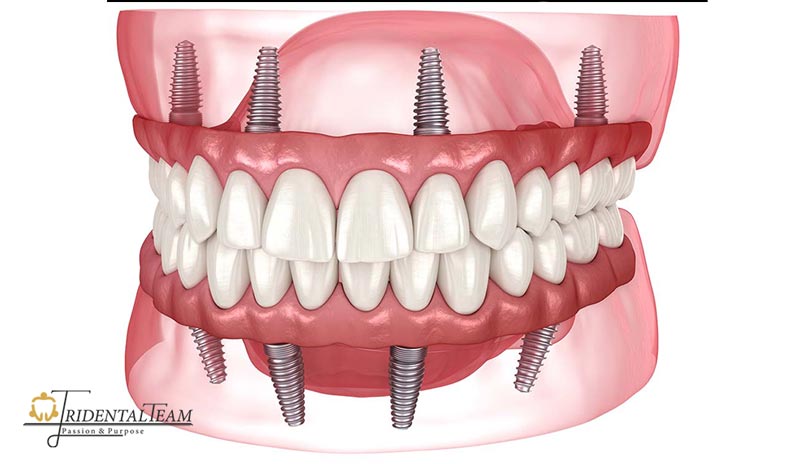 ایمپلنت کامل دو فک بالا و پایین