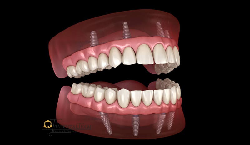 ایمپلنت کامل فک بالا و پایین
