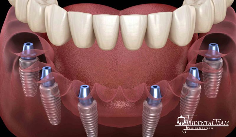 هزینه ایمپلنت کامل فک