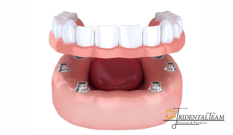 مزایای ایمپلنت فک بالا و پایین