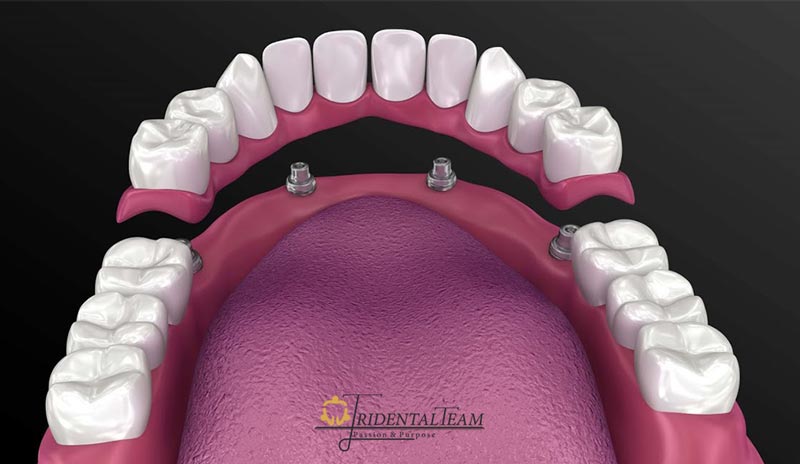 ایمپلنت کامل فک