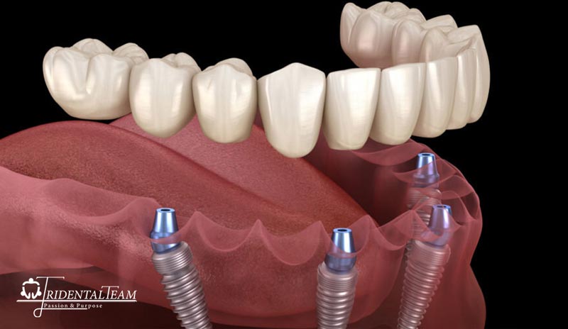 کاندیدای مناسب فک بالا و پایین
