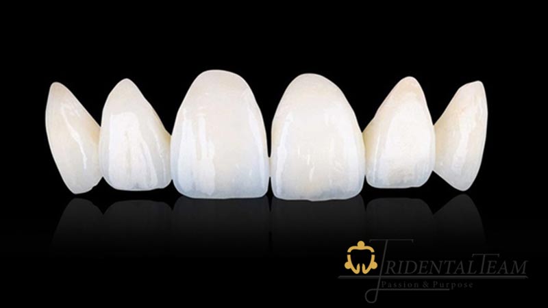 مزایای تعویض روکش دندان