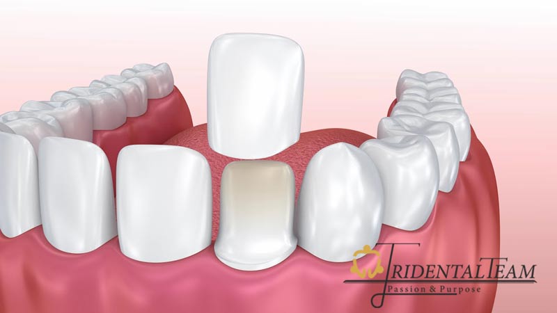 تعویض روکش دندان