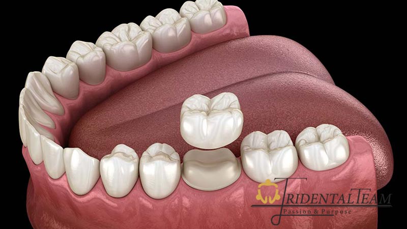 هزینه تعویض روکش دندان در تهران