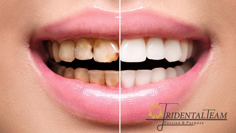 تفاوت لمینت و بلیچینگ