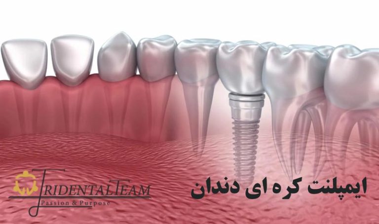 ایمپلنت کره ای دندان