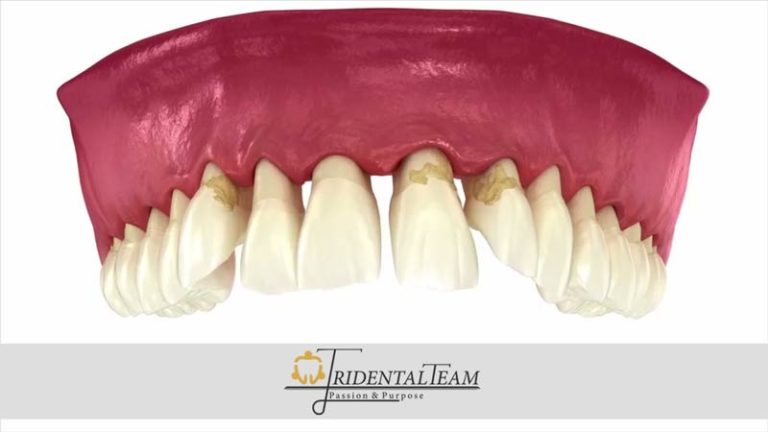 تحلیل لثه چیست