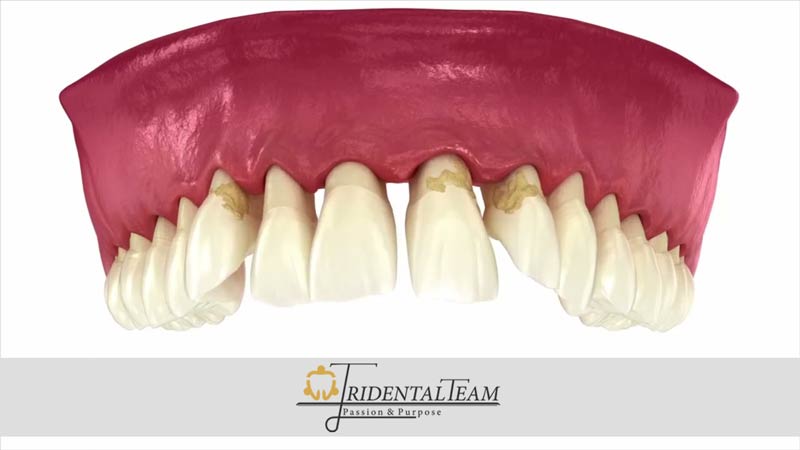 تحلیل لثه چیست