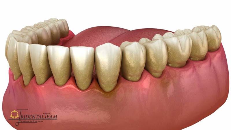 درمان عقب رفتگی لثه یا تحلیل لثه