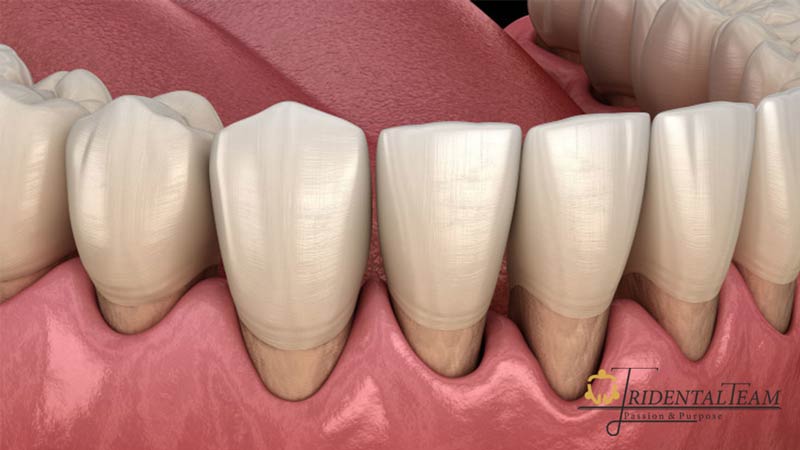 درمان تحلیل لثه در تهران