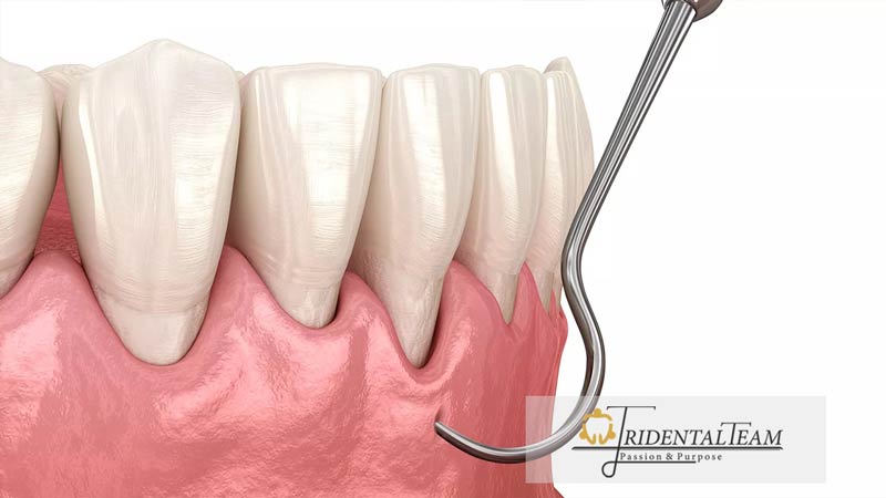 عقب رفتگی لثه