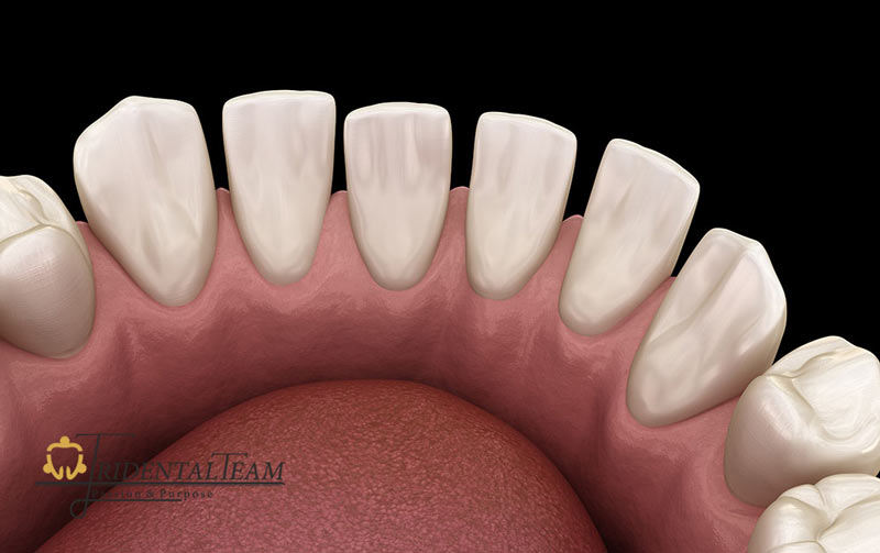 اصلاح فاصله بین دندان ها