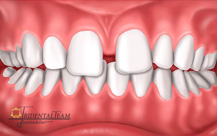 درمان فاصله بین دندان