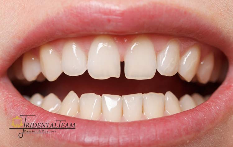 بستن فاصله بین دندان ها